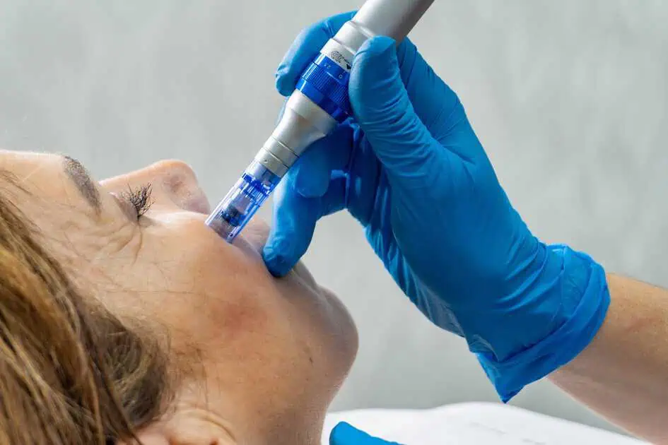 Microneedling Treatments in Brookfield, WI by Luna Med Spa