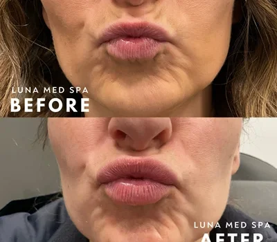 10- half syringe lip filler