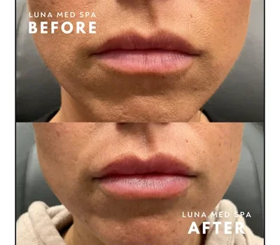 15-lip filler