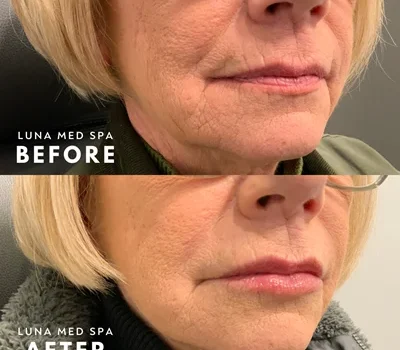 18 lip and lower face filler