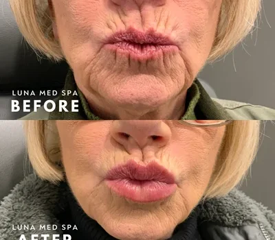 19 lip and lower face filler