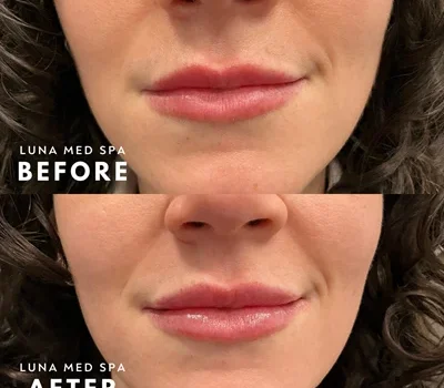 20- half syringe lip filler