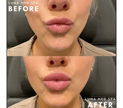 25- lip filler