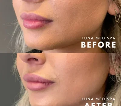 57 lip filler