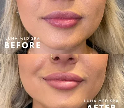 58 lip filler