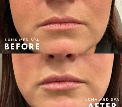 6- half syringe lip filler