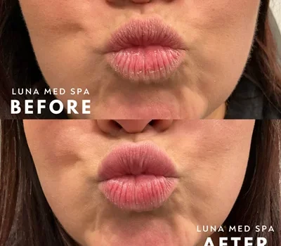 8- half syringe lip filler