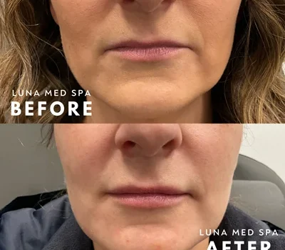 9- half syringe lip filler