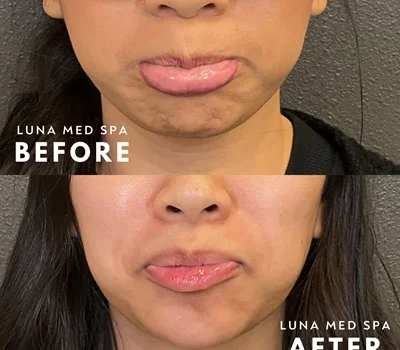 chin and lip flip tox by lunamedspaw in Brookfield, WI