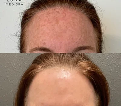 clear & brilliant forehead
