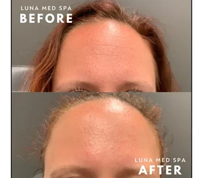 forehead tox by lunamedspaw in Brookfield, WI