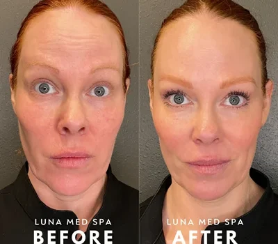 full face tox before-after