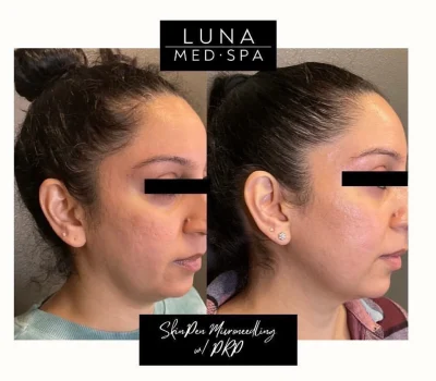 skinpen by lunamedspaw in Brookfield, WI