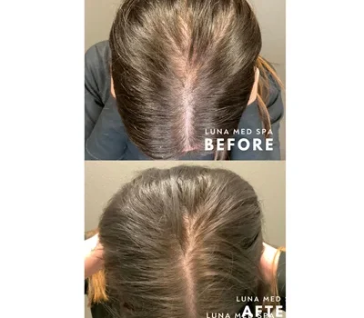 sylfirm x series hair restoration